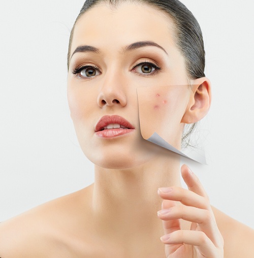 7 Best Products to Control Acne