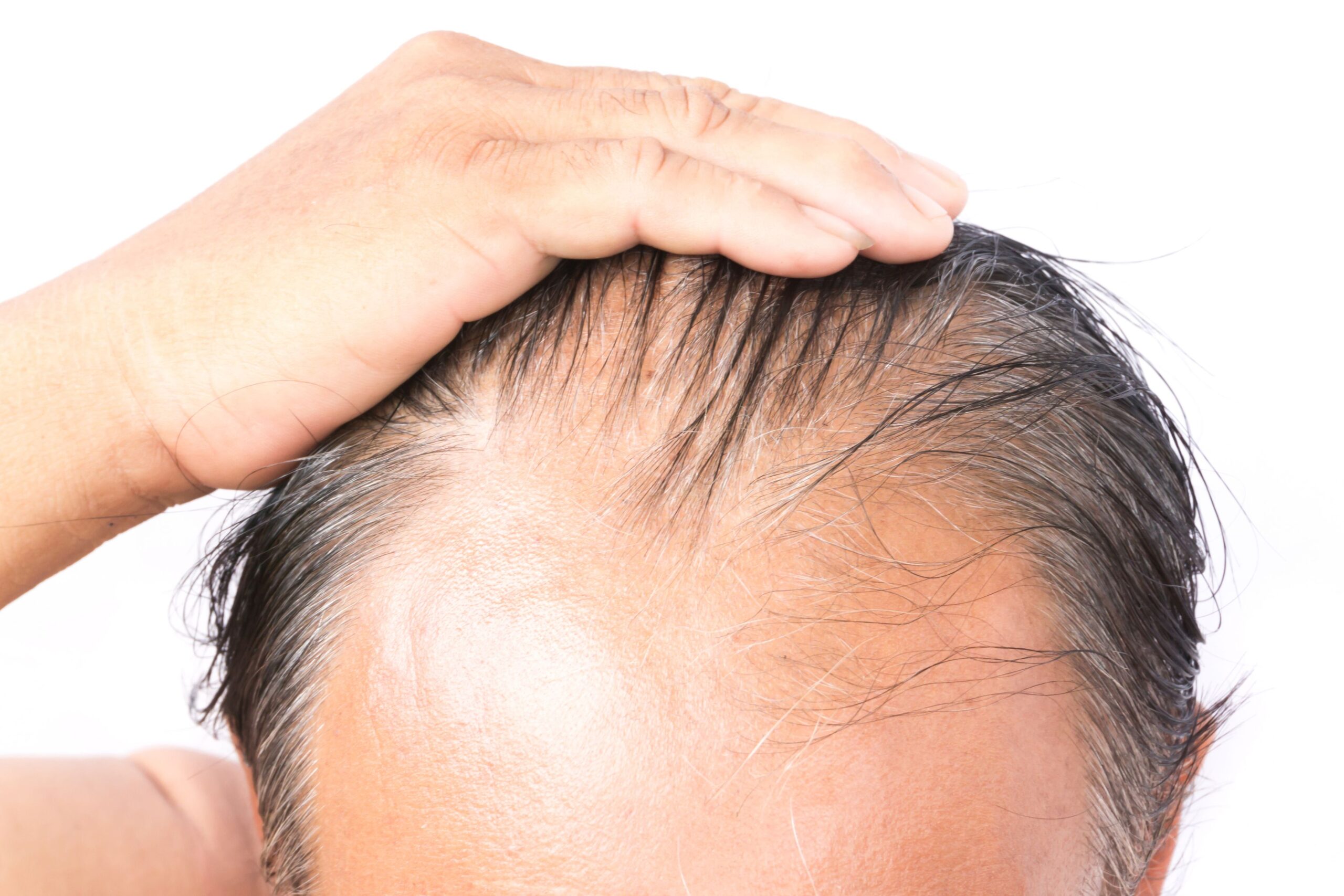 hairfall-causes