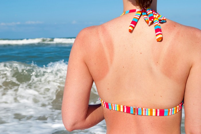 5 Ways to Getting Rid of Sun Tan Naturally